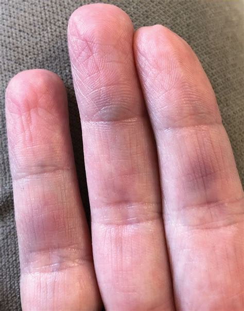 Understanding Pop Blood Vessel in Finger: Causes, Symptoms, and Treatments - A Comprehensive Guide